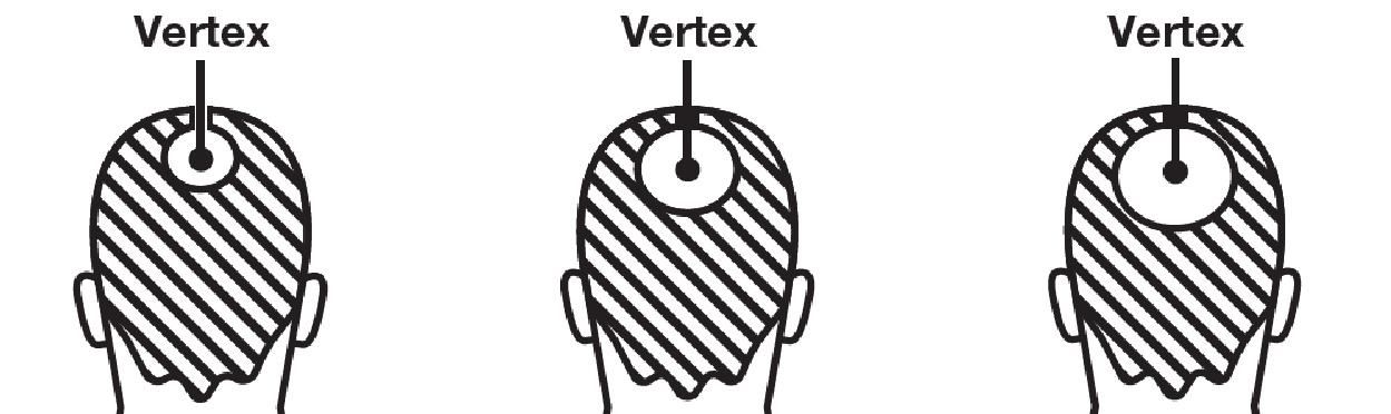 Pill image for Thirty Madison Inc Minoxidil Topical Solution Usp, 5% Drug Facts