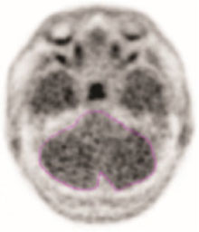 Pill image for These Highlights Do Not Include All The Information Needed To Use Tauvid Safely And Effectively. See Full Prescribing Information For Tauvid.