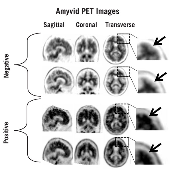 Pill image for These Highlights Do Not Include All The Information Needed To Use Amyvid Safely And Effectively. See Full Prescribing Information For Amyvid.