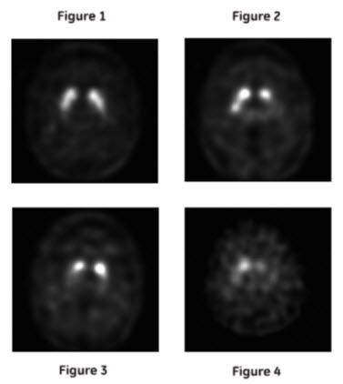 Pill image for These Highlights Do Not Include All The Information Needed To Use Datscan Safely And Effectively. See Full Prescribing Information For Datscan.