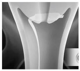 Pill image for These Highlights Do Not Include All The Information Needed To Use Cervidil Safely And Effectively. See Full Prescribing Information For Cervidil.