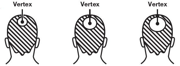 Pill image for Thirty Madison Inc Minoxidil Topical Aerosol 5% Foam Drug Facts